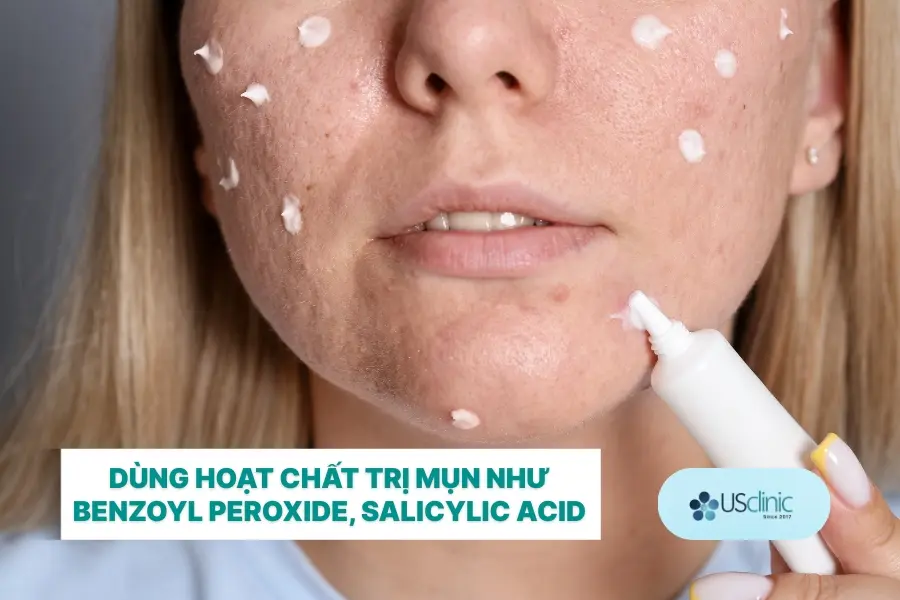 Dùng các hoạt chất trị mụn như benzoyl peroxide, salicylic acid