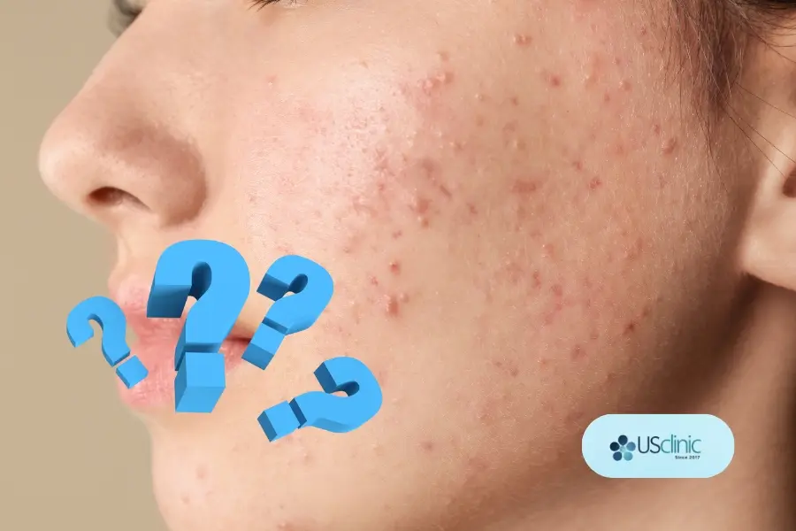 Mụn trứng cá là gì